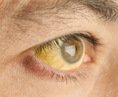  Llaman a prevenir la hepatitis en la Huasteca