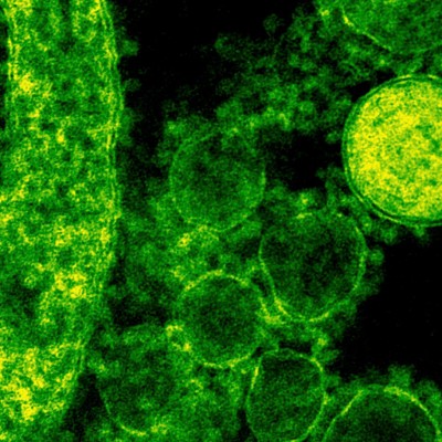  Qué es el virus MERS: ¿debe preocuparnos?