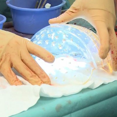  Trasplantan cráneo impreso en 3D a niña con hidrocefalia