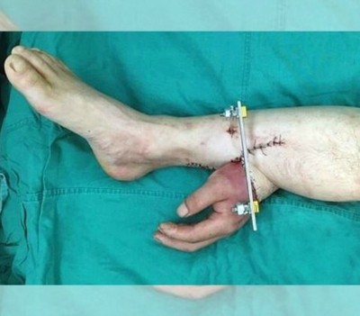  Injertar la mano en la pierna: la técnica china para salvar una extremidad