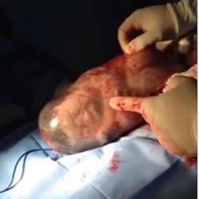  Sorprende imagen de recién nacido bostezando dentro de saco amniótico