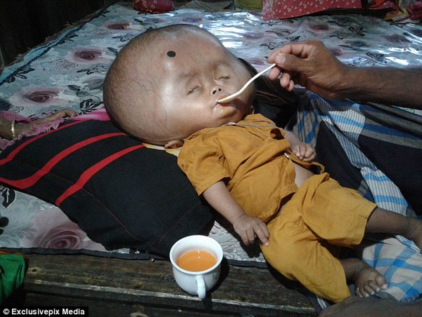  Padres en Bangladesh piden ayuda para su bebé con hidrocefalia