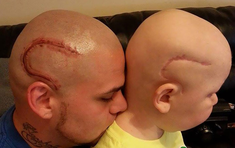  Se tatúa cicatriz igual a la de su hijo tras cirugía