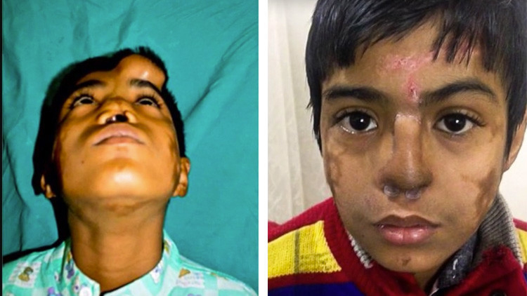  El milagro médico que le cambió la vida a un niño sin nariz