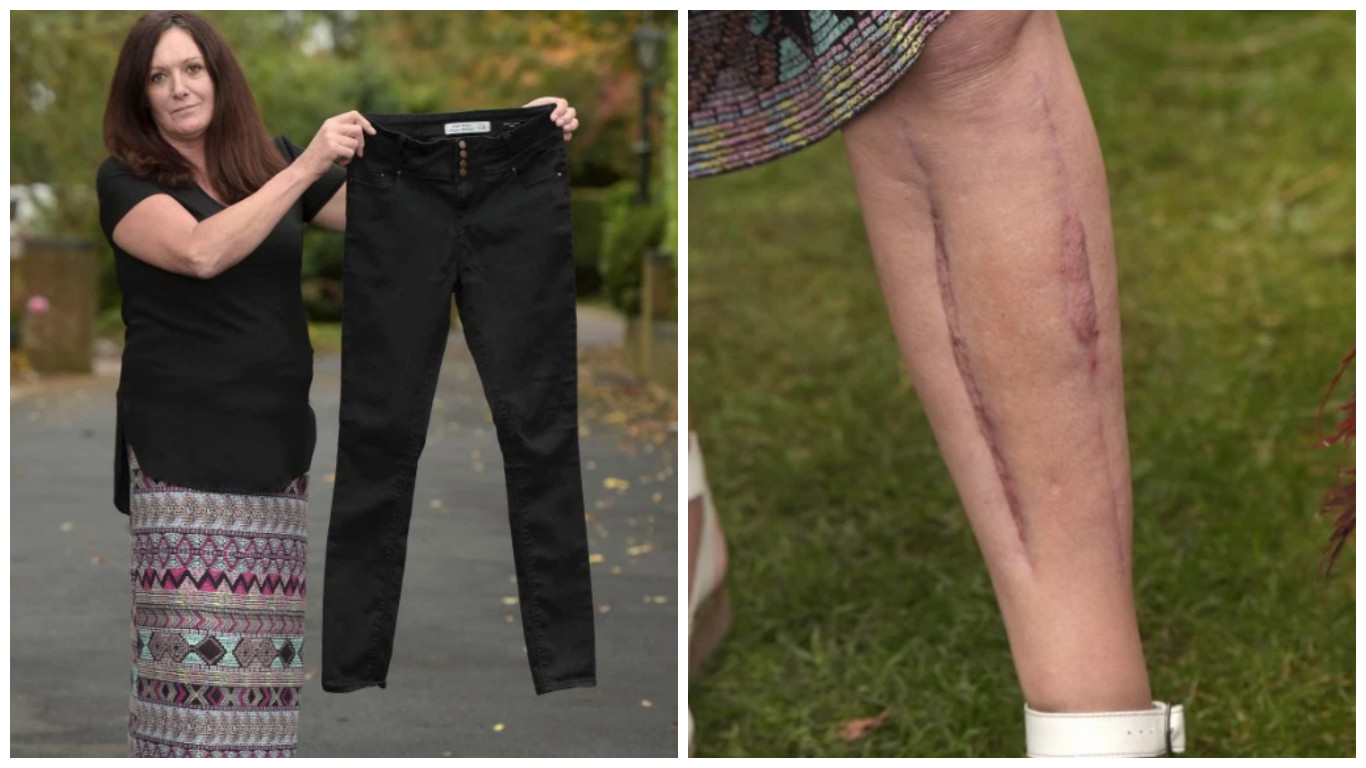  Mujer estuvo a punto de perder las piernas por usar jeans ajustados