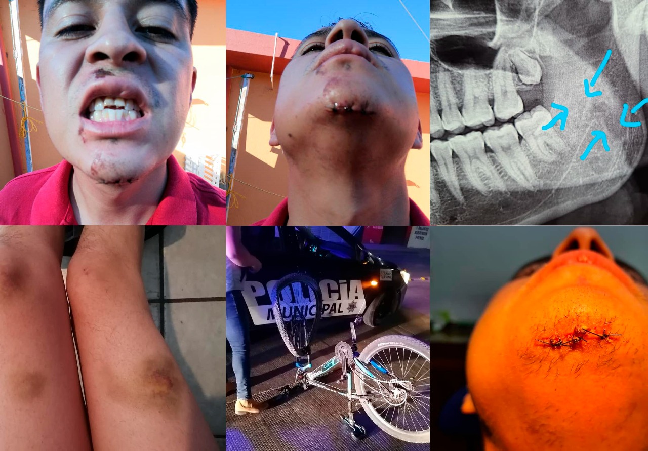  Policías de Soledad atropellan a joven en bicicleta; intentan convencerlo de no denunciarlos