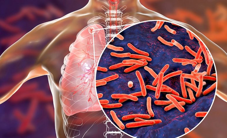 Registran 7 casos de tuberculosis en Rioverde