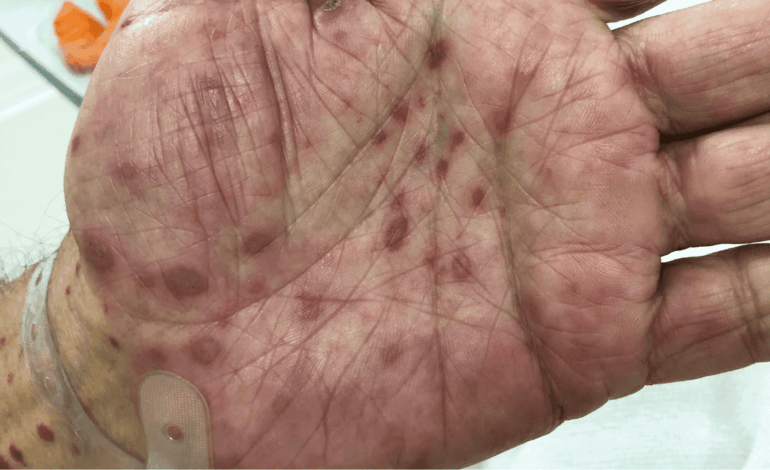  SLP registra 488 casos de sífilis adquirida