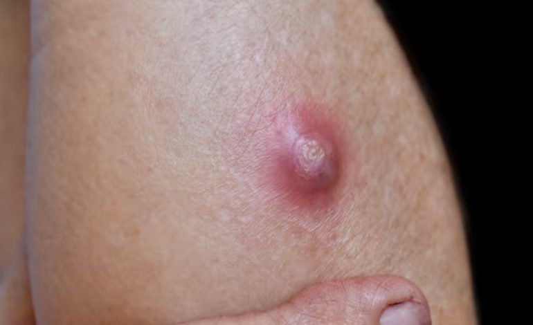  Detectan en SLP dos casos de gusano barrenador en humanos